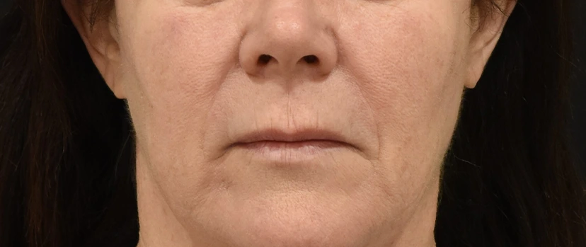 Lip Lift Patient 9 Set 1 Before